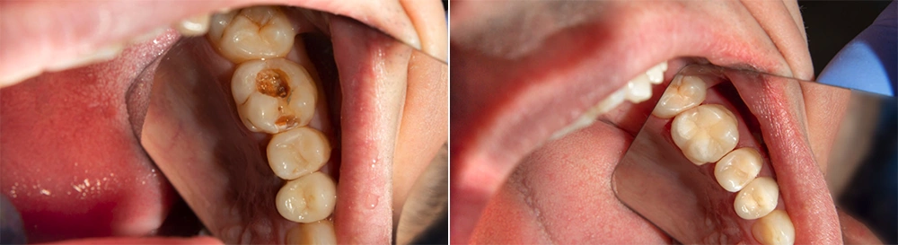 Mortillaro Devitalizzazione 2 Tablet