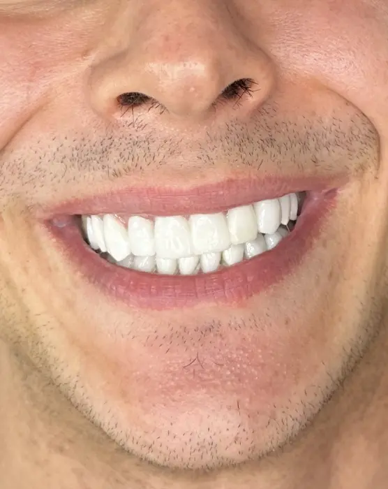 Mortillaro Faccette Dentali