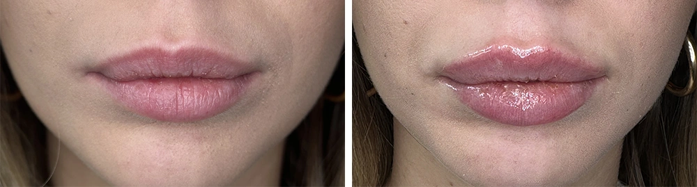 Mortillaro Filler Labbra 3 Tablet